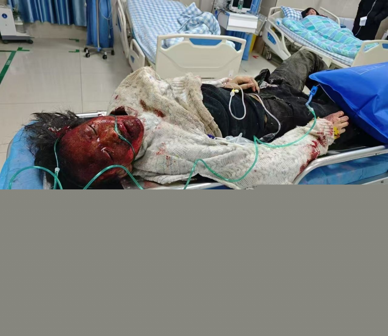 重庆炸井盖重伤1.jpg 重庆炸井盖重伤1.jpg