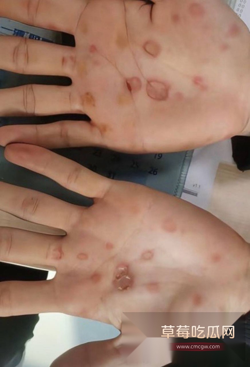 小澈梅毒 7 小澈梅毒 7