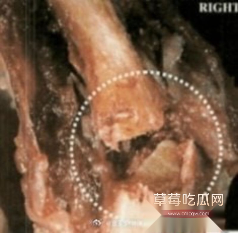 爱泼斯坦自缢后照片首度公开3